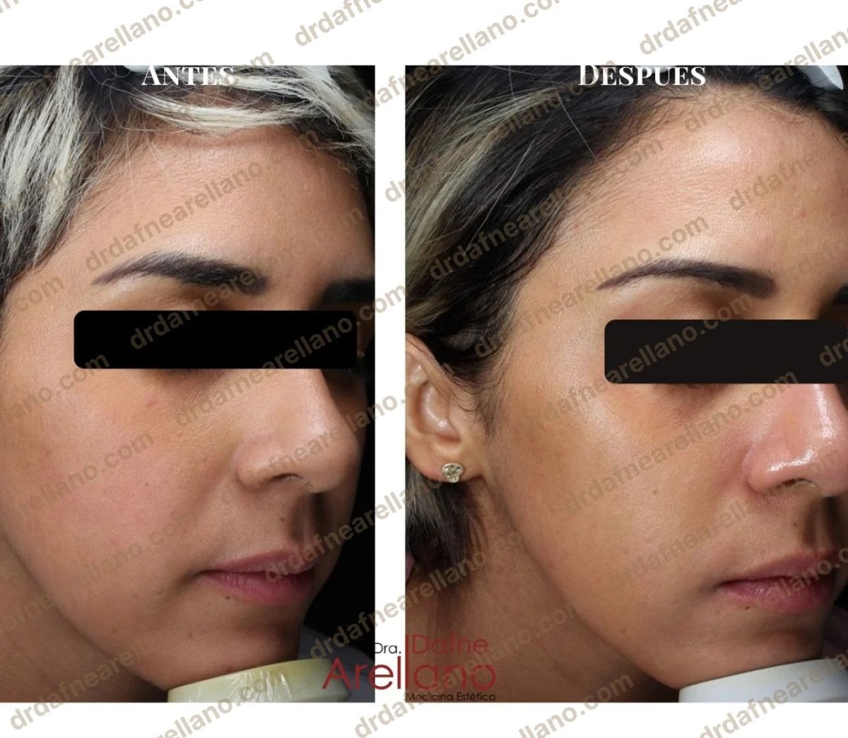 Resultados antes y después de dermoabrasión Hydrafacial, mejora de textura y luminosidad