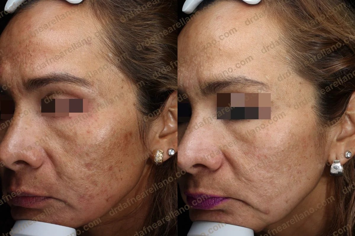 Resultados antes y después del tratamiento láser CO2: mejora de textura y pigmentación facial