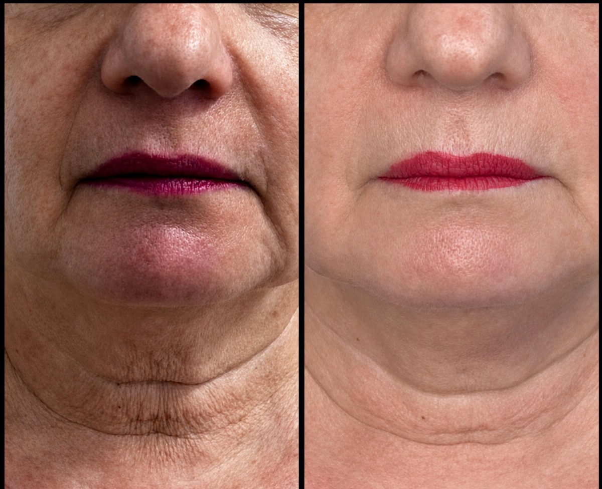 Resultados antes y después de lifting facial sin cirugía – mandíbula más lisa y menos arrugas en el cuello
