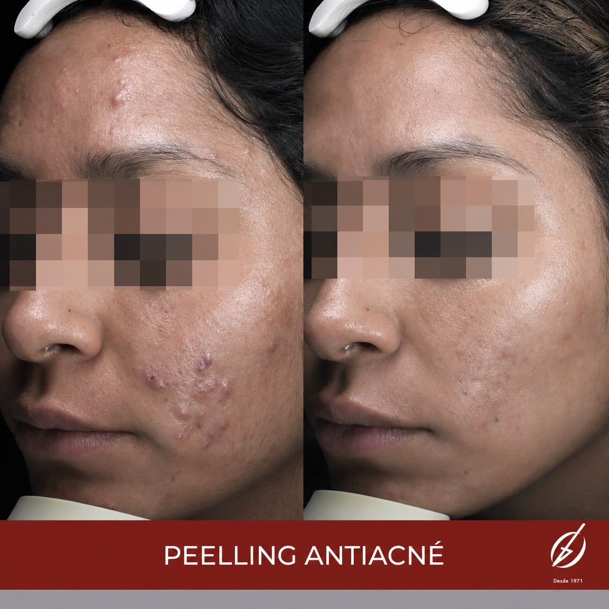 Resultados antes y después de peeling químico antiacné en clínica, mejora visible de la piel