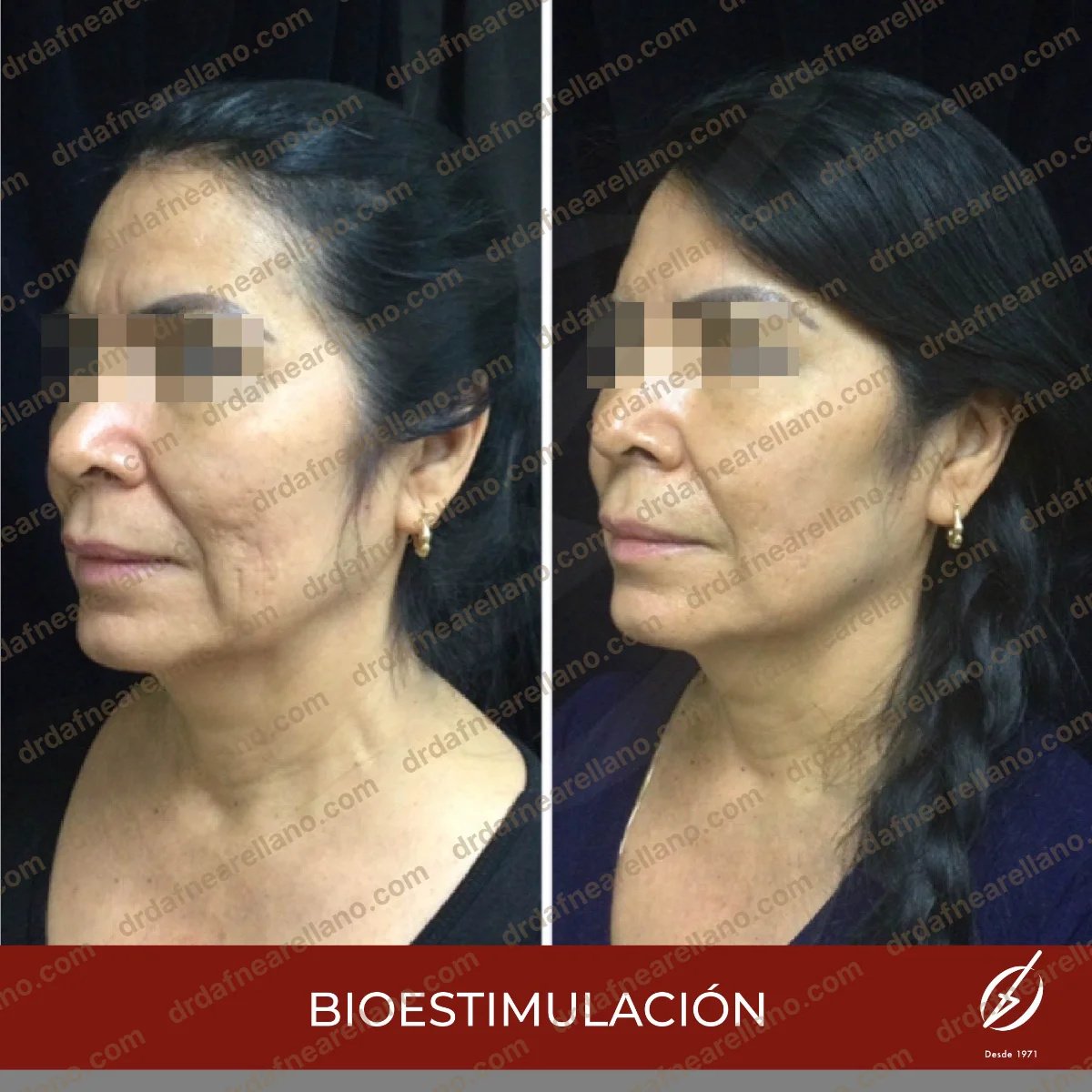Resultados de rejuvenecimiento facial con biostimulación antes y después en Dra. Fine Arellano