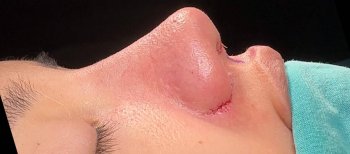 نتيجة عملية تجميل الأنف مع شق واضح، مرحلة الشفاء المبكرة بعد الجراحة