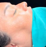 نتيجة عملية تجميل الأنف تظهر شكل الأنف المصقول وتناسق الملامح بعد الجراحة