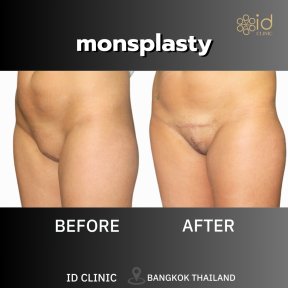 before-after photo mommy-makeover