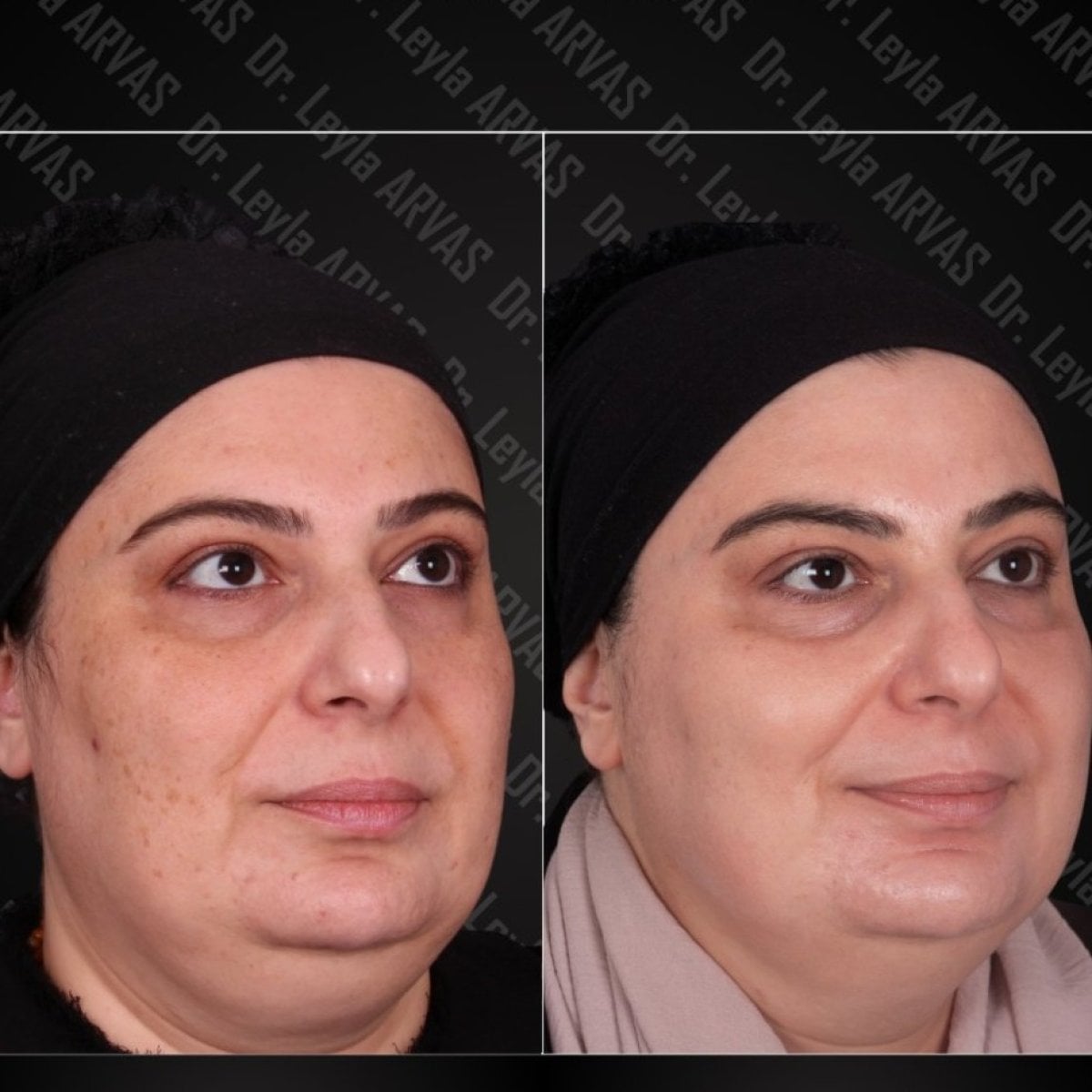 نتائج علاج البشرة IPL قبل وبعد في Quartz Hospital، تحسين لون وملمس البشرة