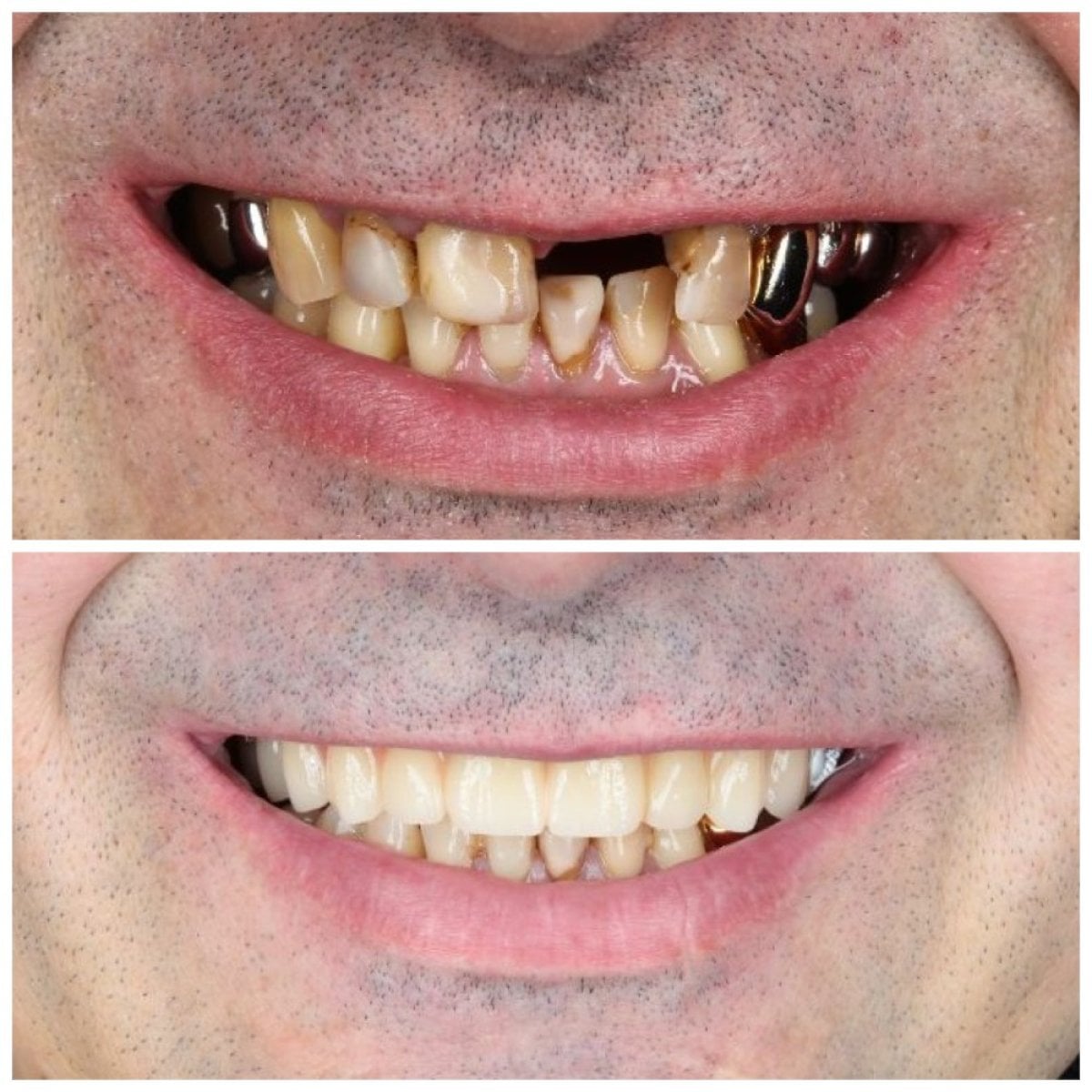نتائج قبل وبعد زراعة الأسنان في عيادة Dynasty Stomatology في كراكوف