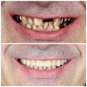 Vorher-nachher-Ergebnisse Zahnimplantate bei Dental Clinic Dynasty Stomatology in Krakau