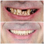 Vorher-nachher-Ergebnisse Zahnimplantate bei Dental Clinic Dynasty Stomatology in Krakau
