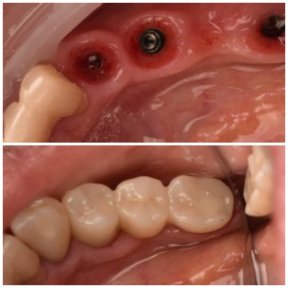 Vorher-nachher-Ergebnisse Zahnimplantate bei Dental Clinic Dynasty Stomatology in Krakau