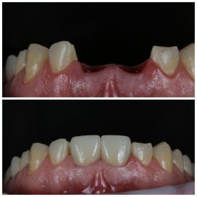 Vorher-nachher-Ergebnisse Zahnimplantat bei Dental Clinic Dynasty Stomatology in Krakau