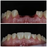 Vorher-nachher-Ergebnisse Zahnimplantat bei Dental Clinic Dynasty Stomatology in Krakau