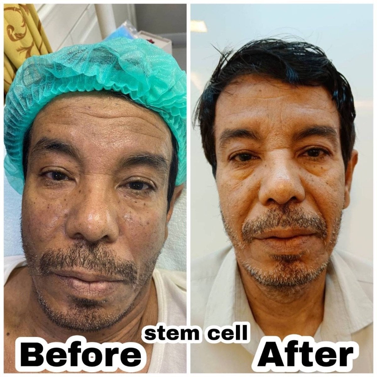 Resultados antes y después de terapia de rejuvenecimiento con células madre en ID Clinic Bangkok