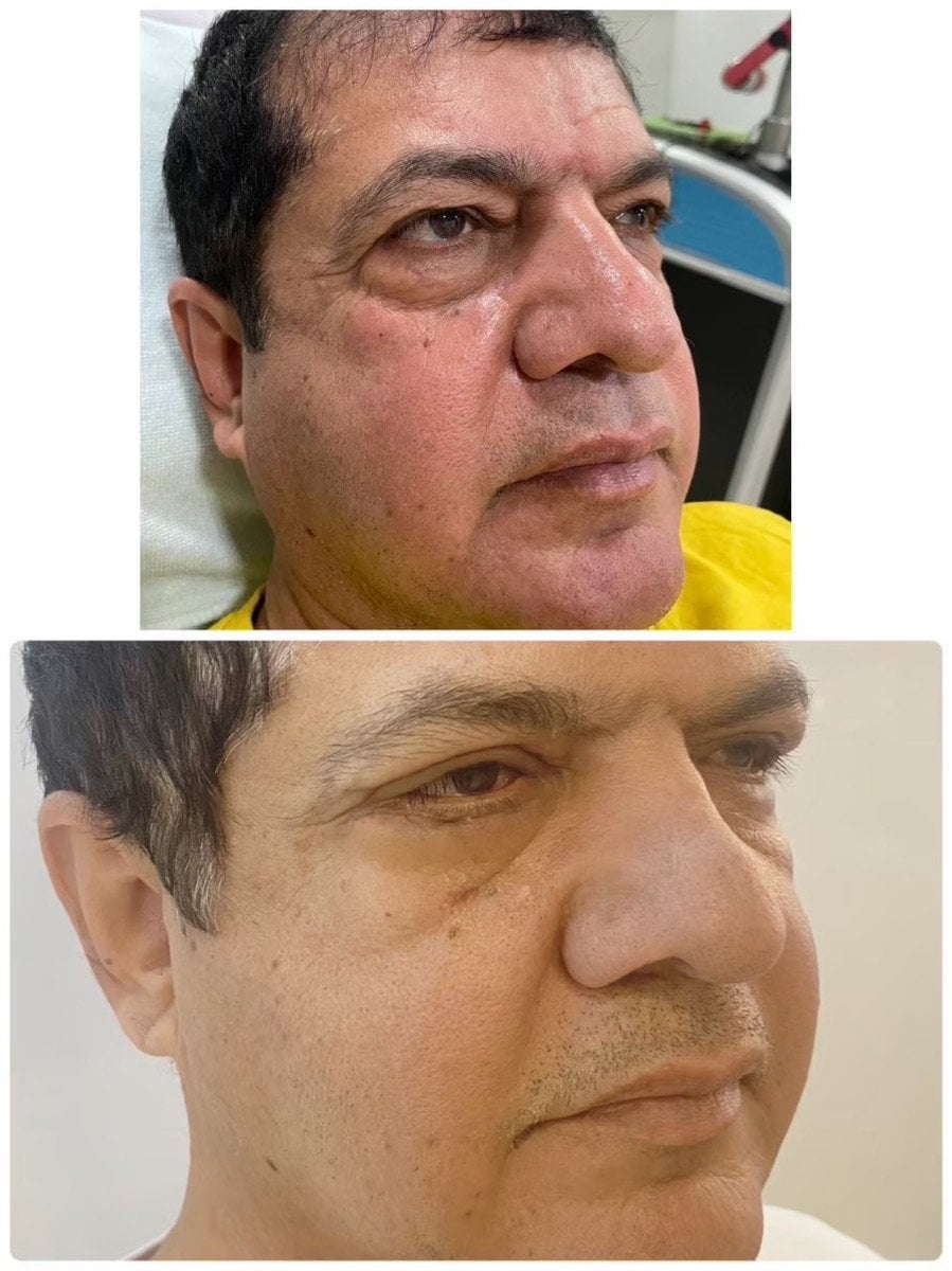 Resultados antes y después de terapia de rejuvenecimiento con células madre en ID Clinic Bangkok