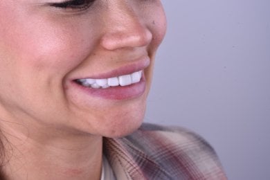 before-after photo implantacia-zuba