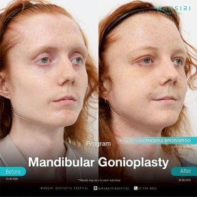 before-after photo podtazka-kozi-lica-fejslift