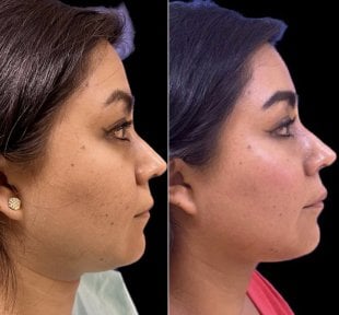 Resultados de lifting de cuello antes y después – mejora del contorno mandibular y cuello