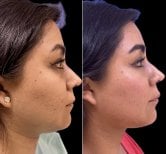 Resultados de lifting de cuello antes y después – mejora del contorno mandibular y cuello