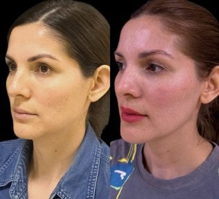 Resultados de lifting de cuello antes y después – mejora visible del contorno mandibular y cuello