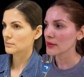Resultados de lifting de cuello antes y después – mejora visible del contorno mandibular y cuello