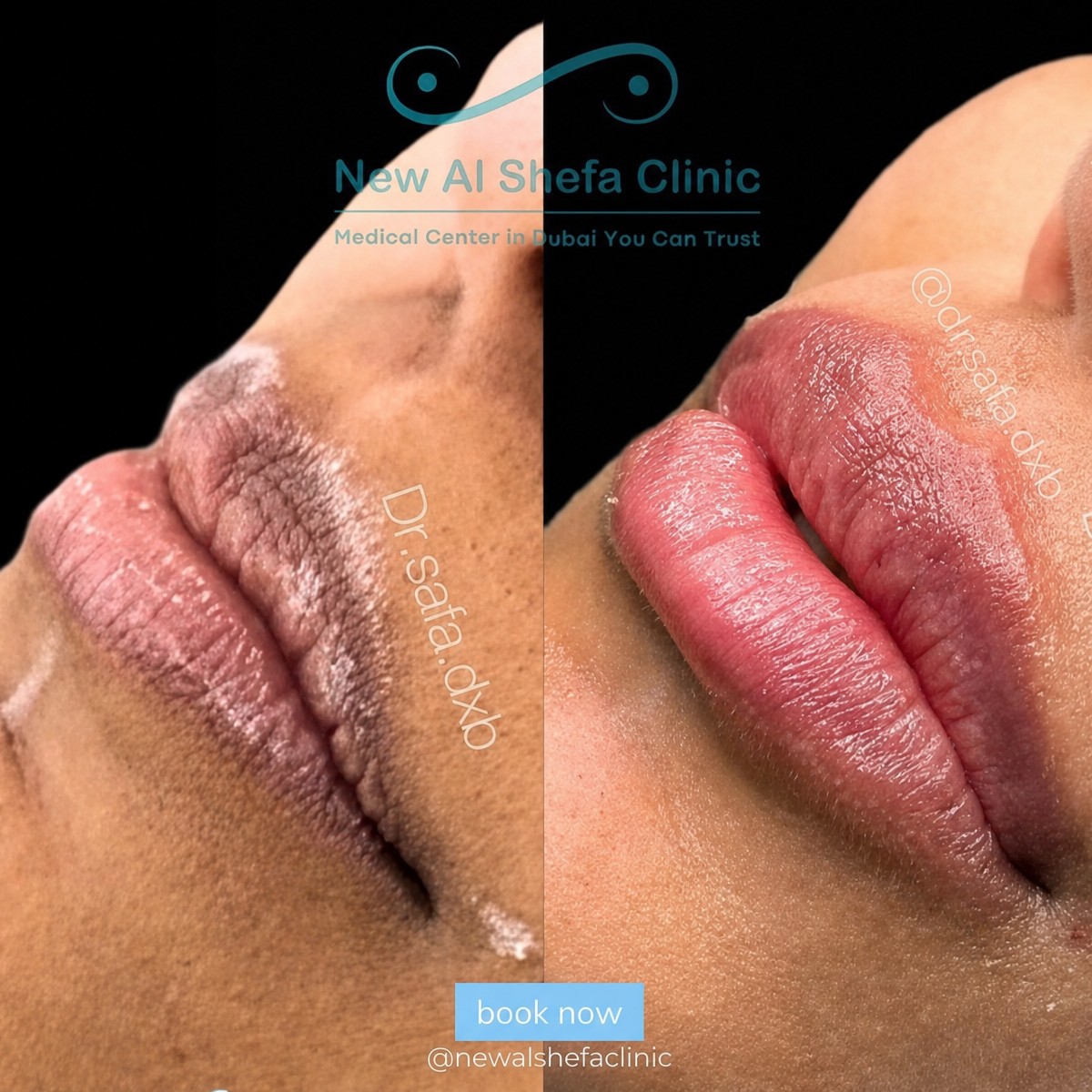نتيجة قبل وبعد حقن فيلر الشفاه في New Al Shefa Clinic، زيادة حجم الشفاه