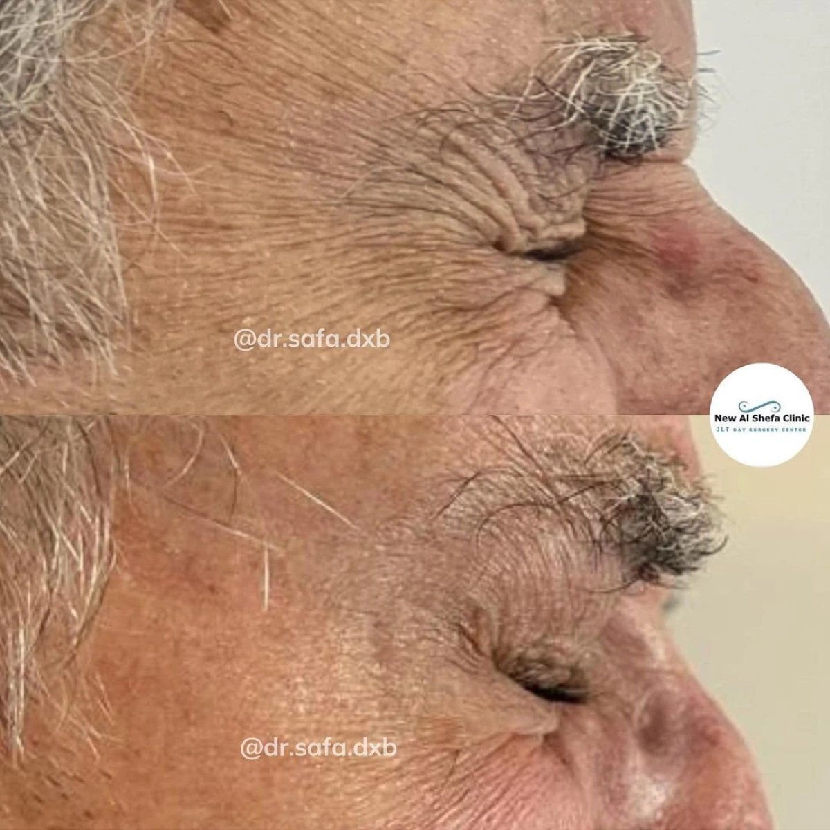 Resultados de blefaroplastia antes y después en New Al Shefa Clinic, menos arrugas en párpados