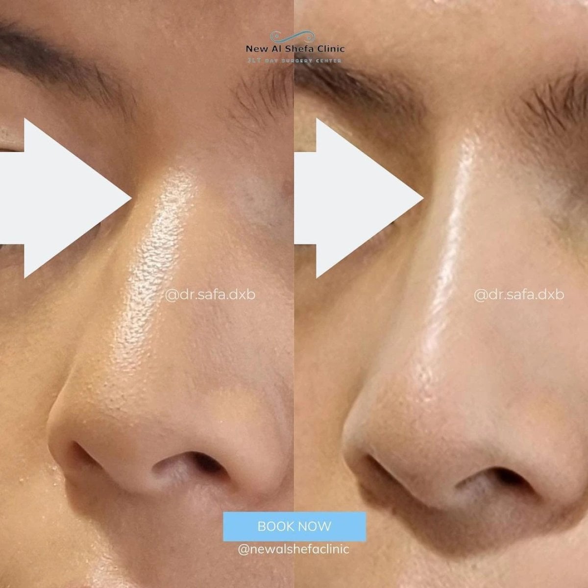 Resultado antes y después de corrección nasal no quirúrgica en New Al Shefa Clinic
