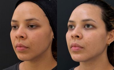 before-after photo fillers-injection