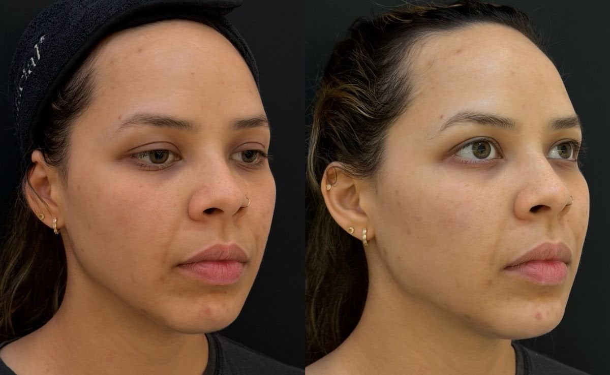 Before and after fillers injection at PERFECT SKIN CANCÚN, facial contour enhancement result