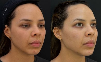before-after photo fillers-injection