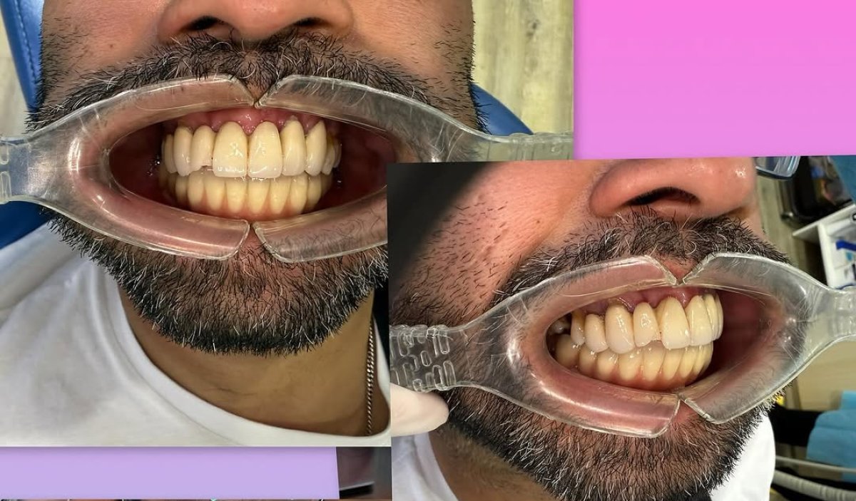 نتيجة قبل وبعد زراعة الأسنان All-on-6 في نفس اليوم، تحسين الابتسامة ومحاذاة الأسنان