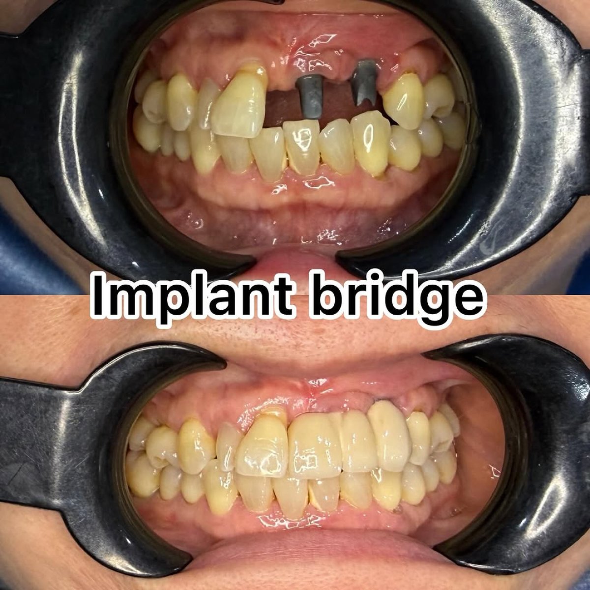 Resultados antes y después de puente dental sobre implantes – sonrisa restaurada