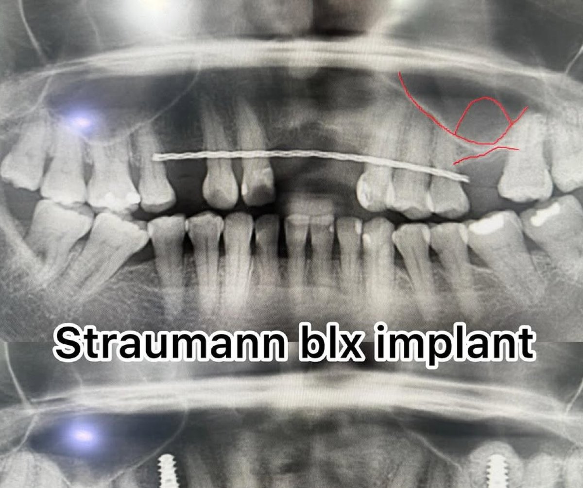 نتائج أشعة قبل وبعد زراعة زرعة Straumann BLX، يظهر موضع الزرعة بوضوح
