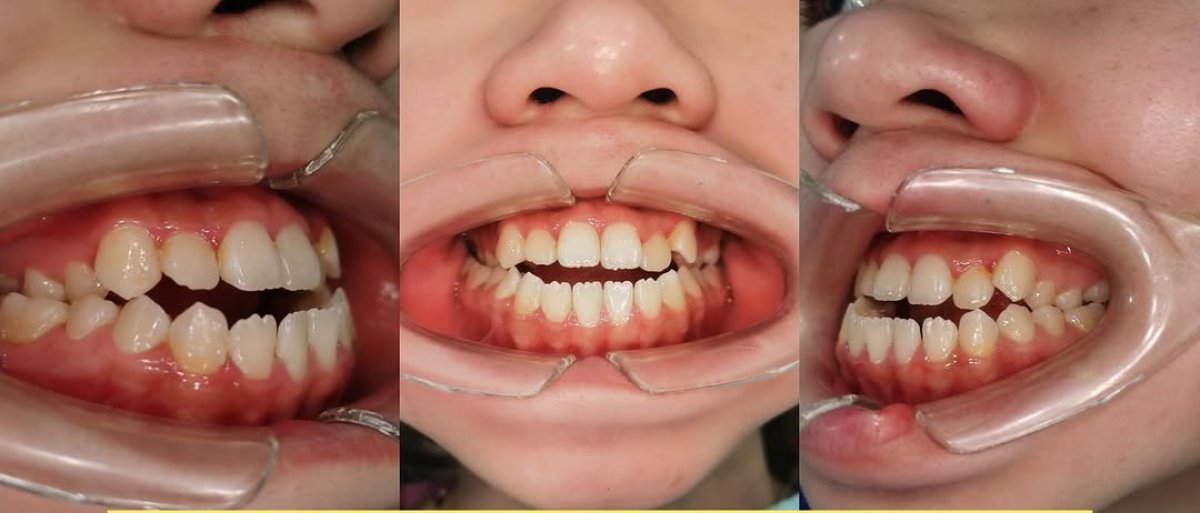 نتائج قبل وبعد تقويم الأسنان الشفاف Invisalign – تحسين انتظام الأسنان وابتسامة مستقيمة