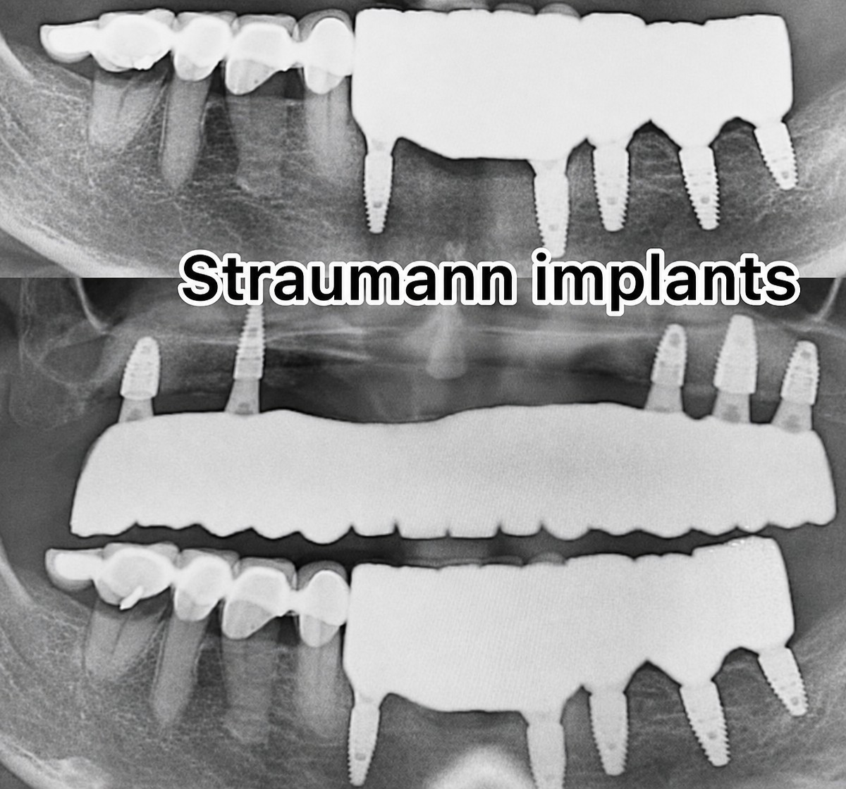 Resultados de implantes dentales Straumann: radiografía panorámica de restauración total