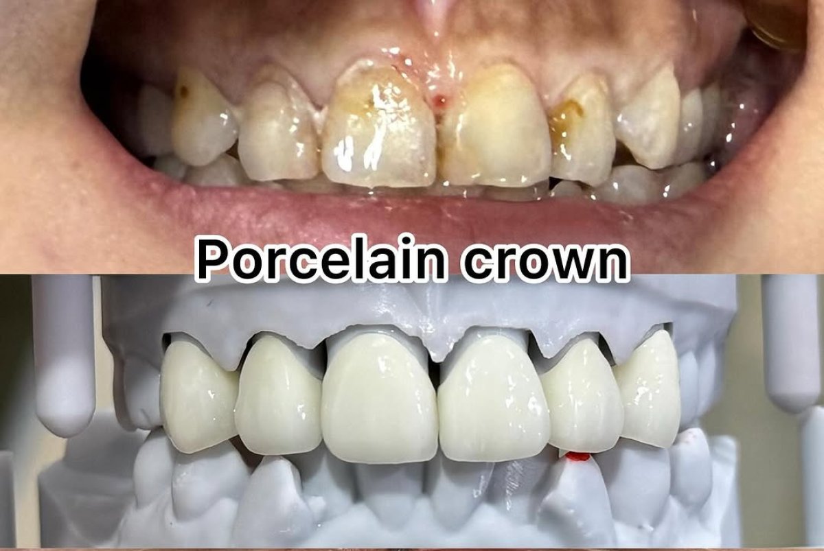 Resultados antes y después de coronas dentales de porcelana: mejora de los dientes frontales