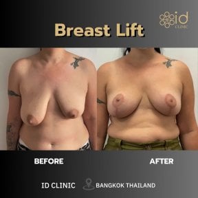 before-after photo 360-liposuction