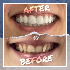 before-after photo hollywood-smile