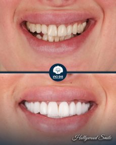 before-after photo hollywood-smile