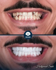 before-after photo hollywood-smile