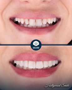 before-after photo hollywood-smile