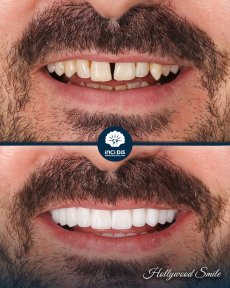 before-after photo hollywood-smile