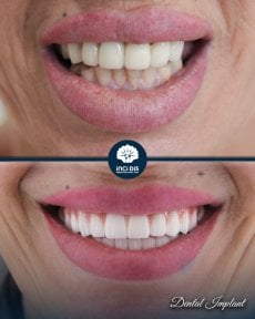 before-after photo dental-implant