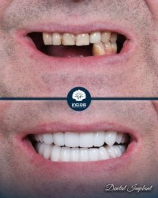before-after photo dental-implant
