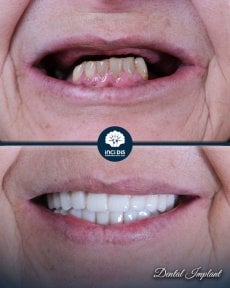 before-after photo dental-implant