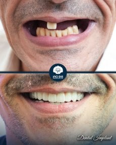 before-after photo dental-implant