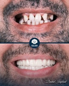 before-after photo dental-implant