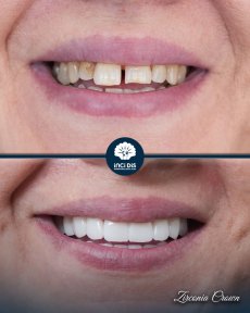 before-after photo zirconia-crown-installation