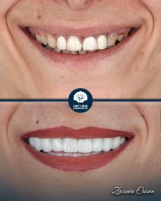 before-after photo zirconia-crown-installation