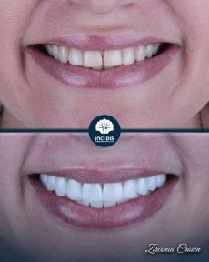before-after photo zirconia-crown-installation