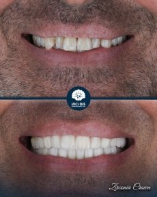 before-after photo zirconia-crown-installation